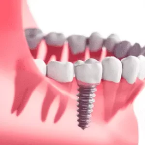 How to Take Care of Your Dental Implants: Proven Ways to Extend Their Lifespan