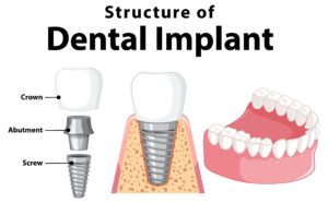 Benefits of Dental Implants Over Traditional Dentures