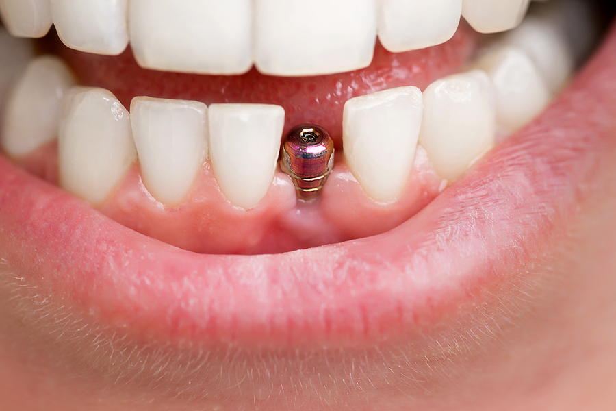 How to Take Care of Your Dental Implants: Proven Ways to Extend Their Lifespan