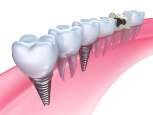 Benefits of Dental Implants Over Traditional Dentures