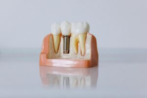 Dental Implants vs Dentures: Smart Choice for Your Oral Health