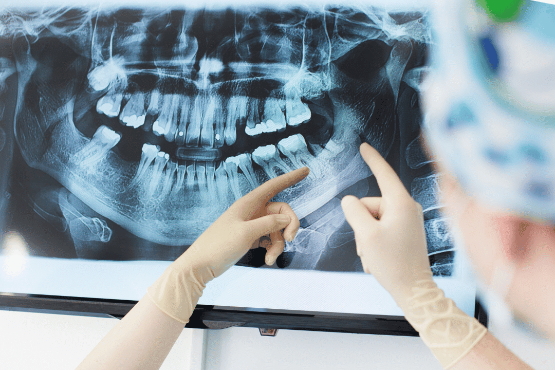 infected tooth x-ray graham