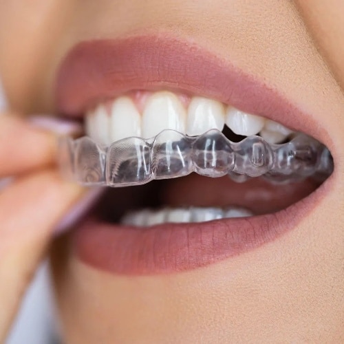 Candidate for Clear Aligner
