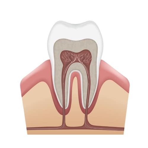 Symptoms need Root Canal treatment