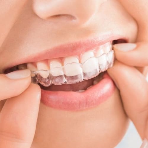 Why Choose Invisalign