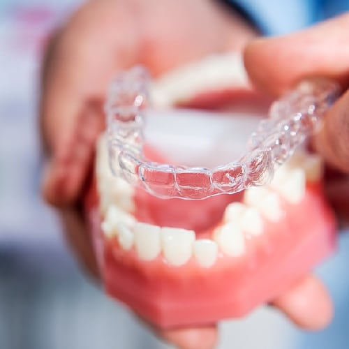 clear aligner