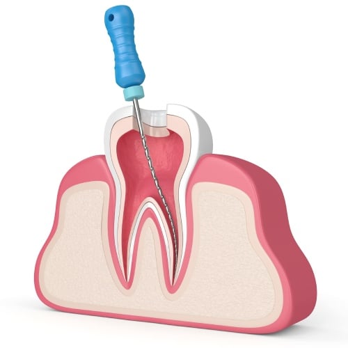 root canal treatment