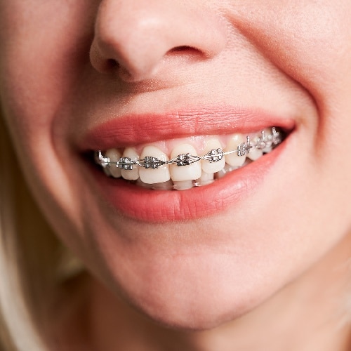 Getting Braces in Puyallup