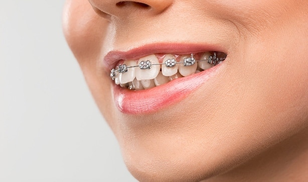 Smile with Braces in Puyallup and Graham