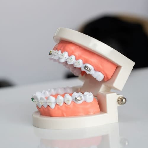 Ceramic Braces in
