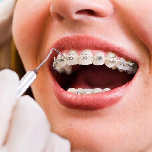 Braces Treatment in Puyallup