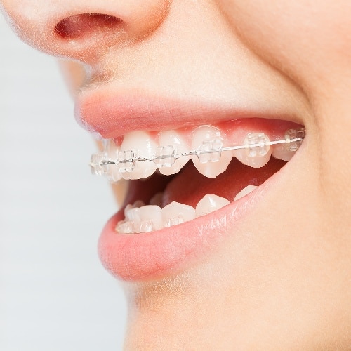 Looking for braces in Puyallup