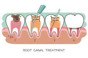 What is a root canal and how is it treated