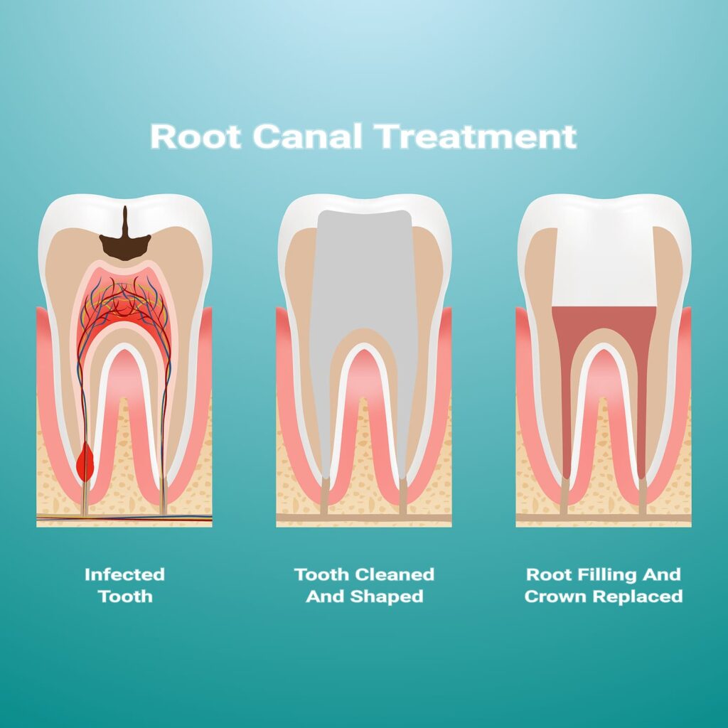 What is a root canal treatment?