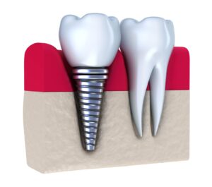What is the average cost of dental implants